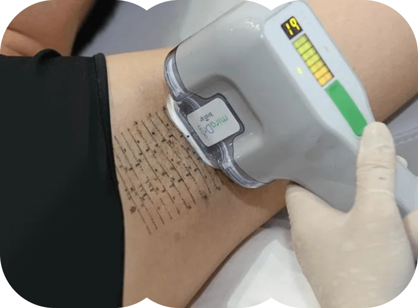 Hyperhidrosis Treatment