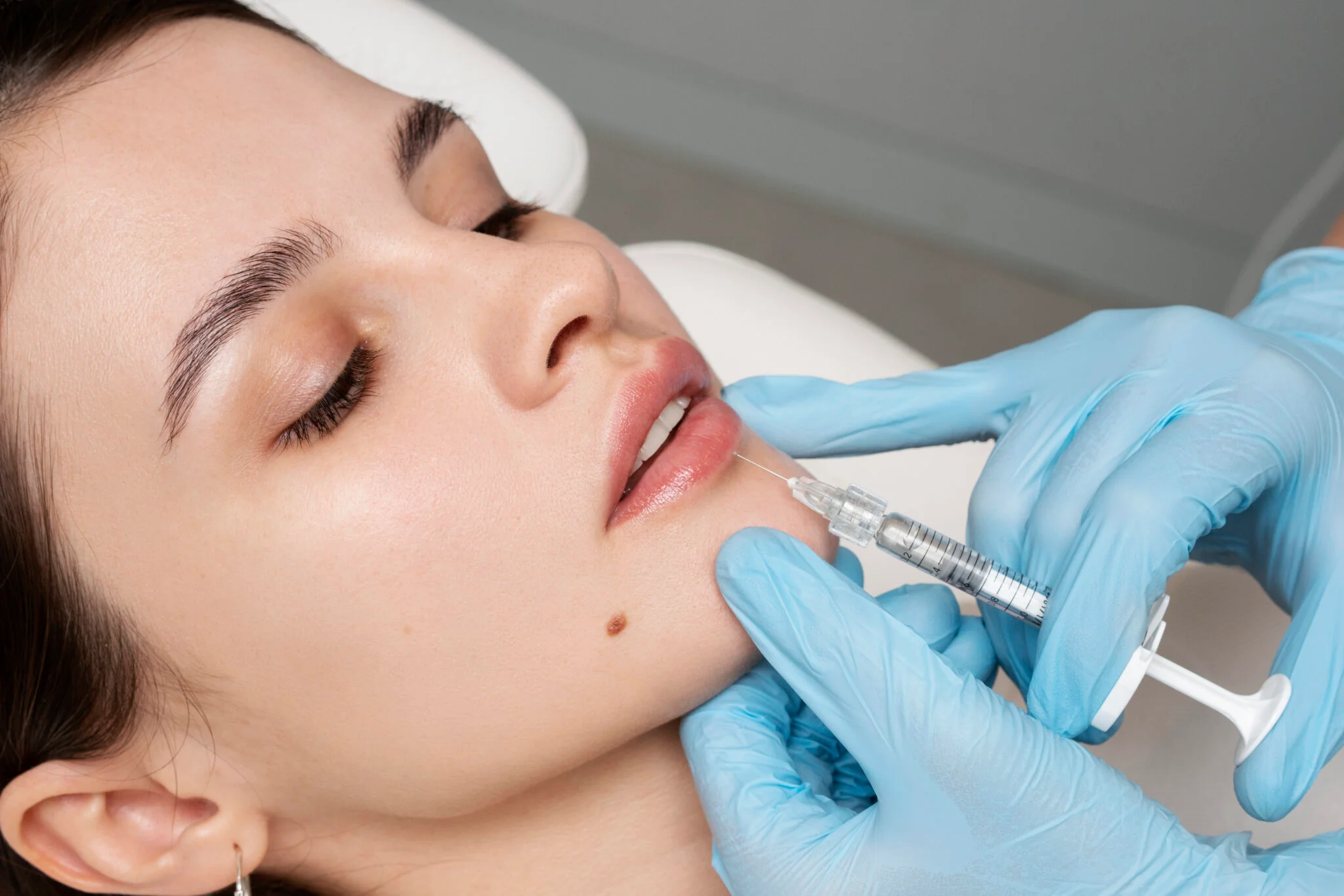 Lip Augmentation